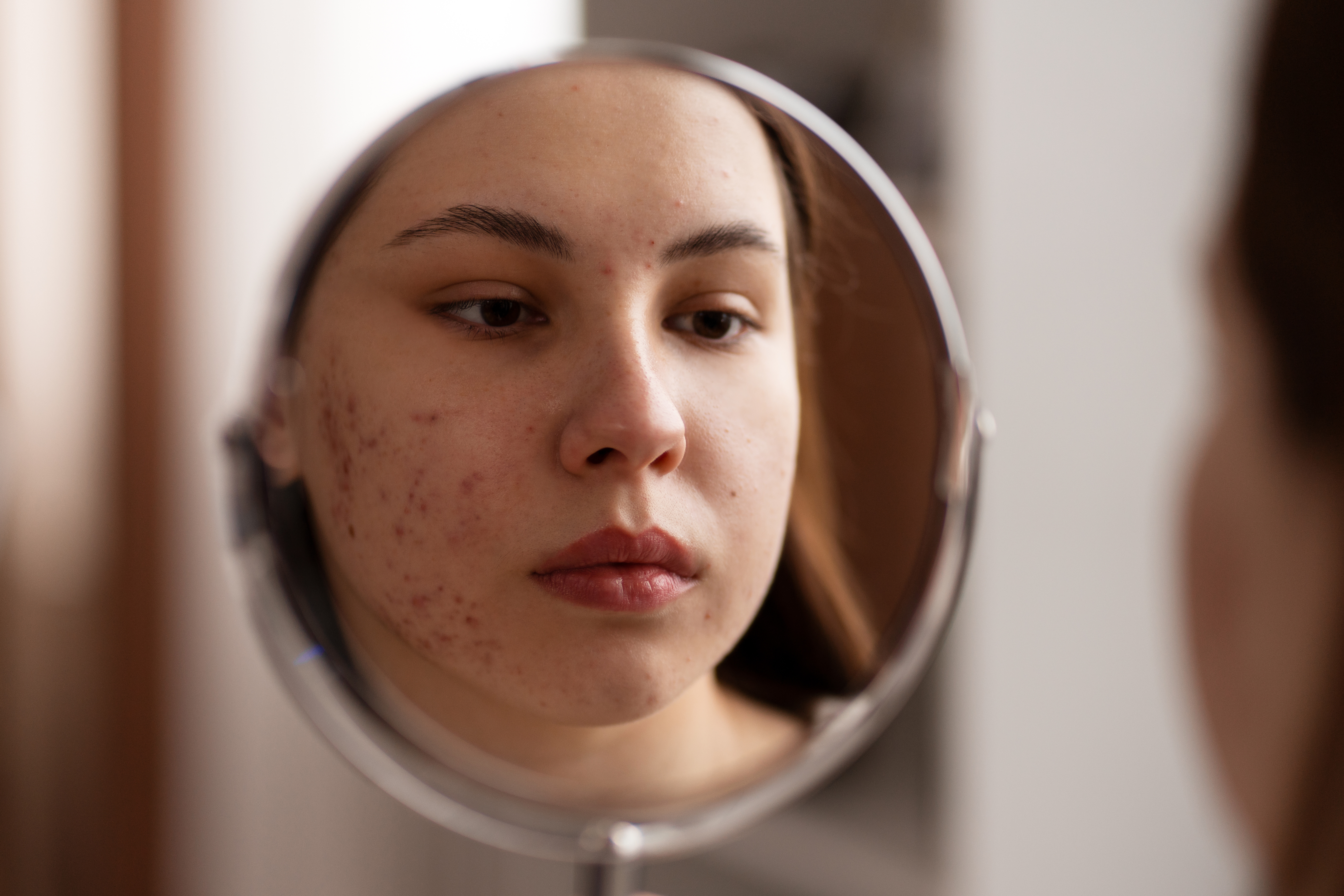 person dealing with rosacea 1 a91da