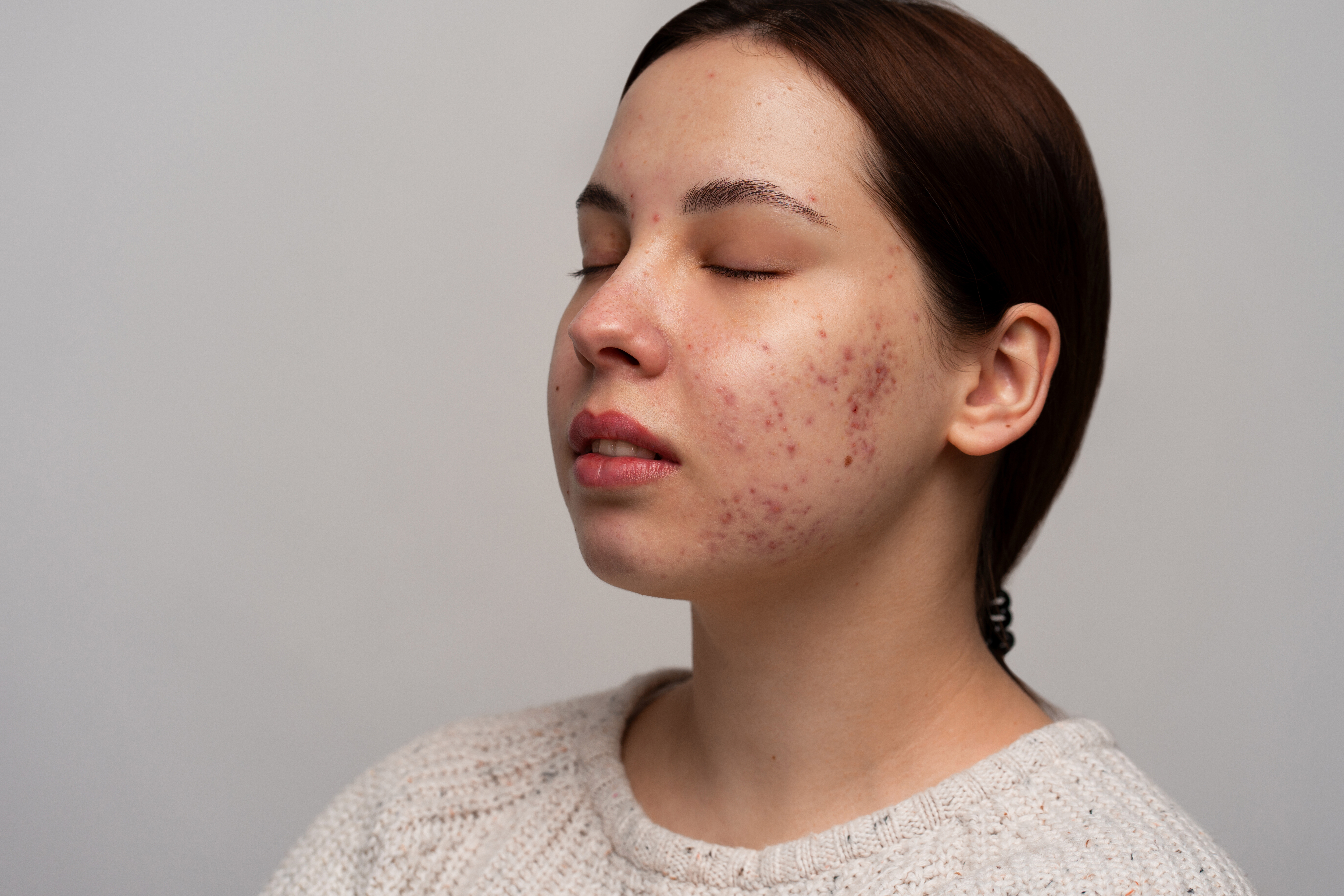 person dealing with rosacea 42577