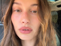 Hailey Bieber: Μιλάει ανοιχτά για την περιστοματική δερματίτιδα και εξηγεί πώς την αντιμετωπίζει όταν εμφανίζεται